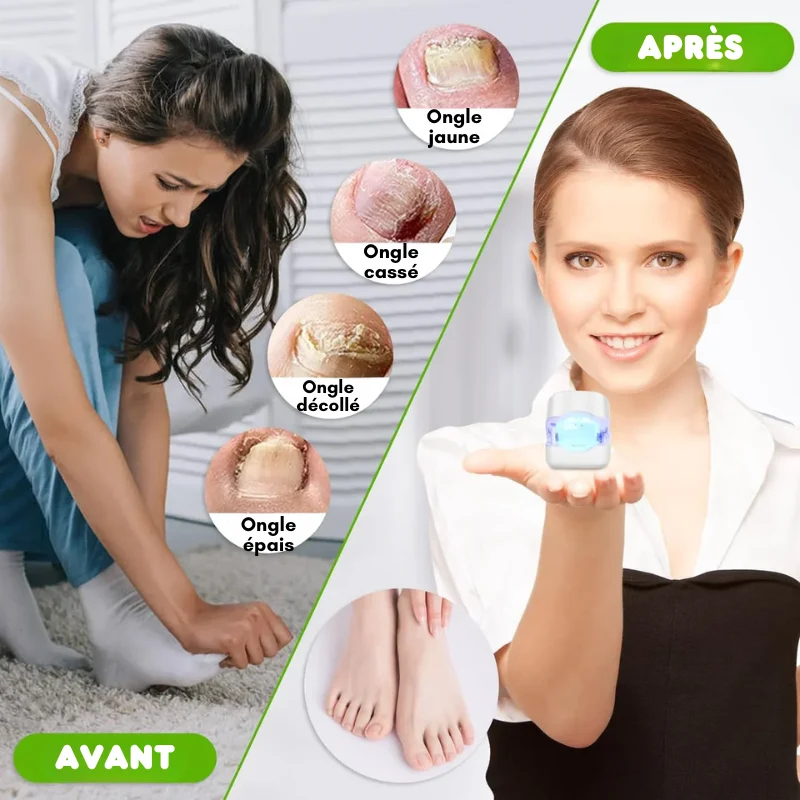 Appareil de traitement au laser pour ongles anti-mycose
