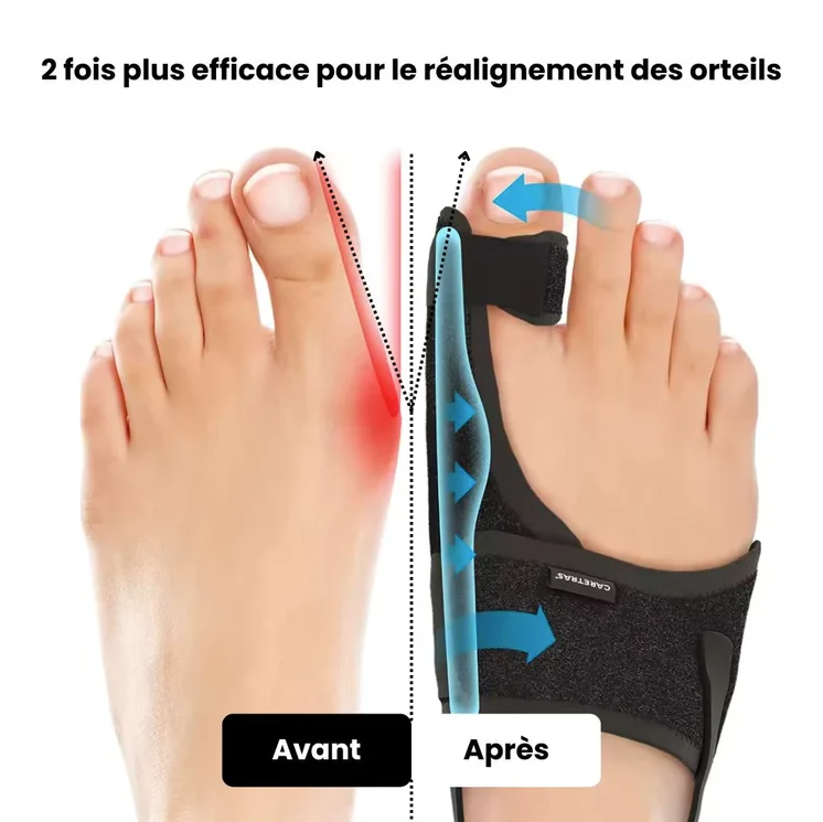 Attelle Hallux Valgus Réglable avec Barre Métallique