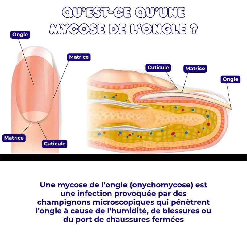32x Patchs de Traitement Anti-Mycose pour Pieds