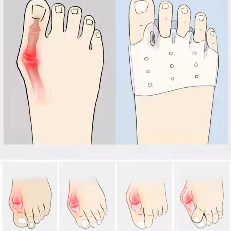 4x Coussinets en Silicone pour l'avant-pied - Alignement des orteils
