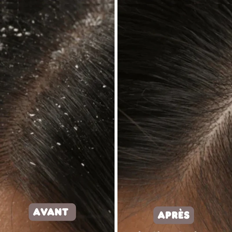 Peigne Anti-Pellicules Auto-nettoyant & Antistatique