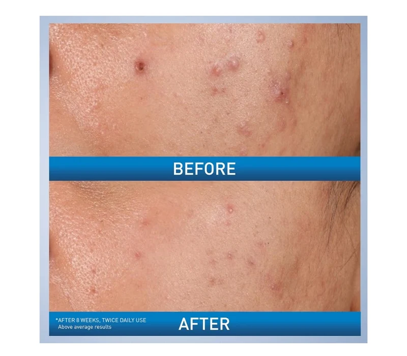 CeraVe Acne Control Gel, 2% Salicylic Acid Treatment w/ Glycolic Acid + Lactic Acids, Alcohol Free & Oil Free (1.35 Fl Oz)