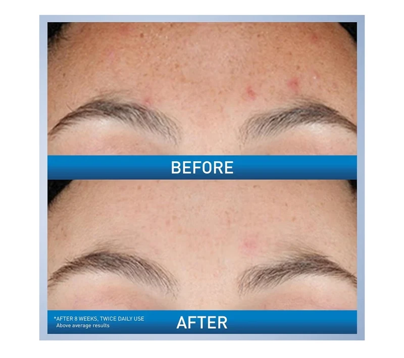 CeraVe Resurfacing Retinol Serum Formulated w/ Licorice Root Extract & Niacinamide,Non-Comedogenic