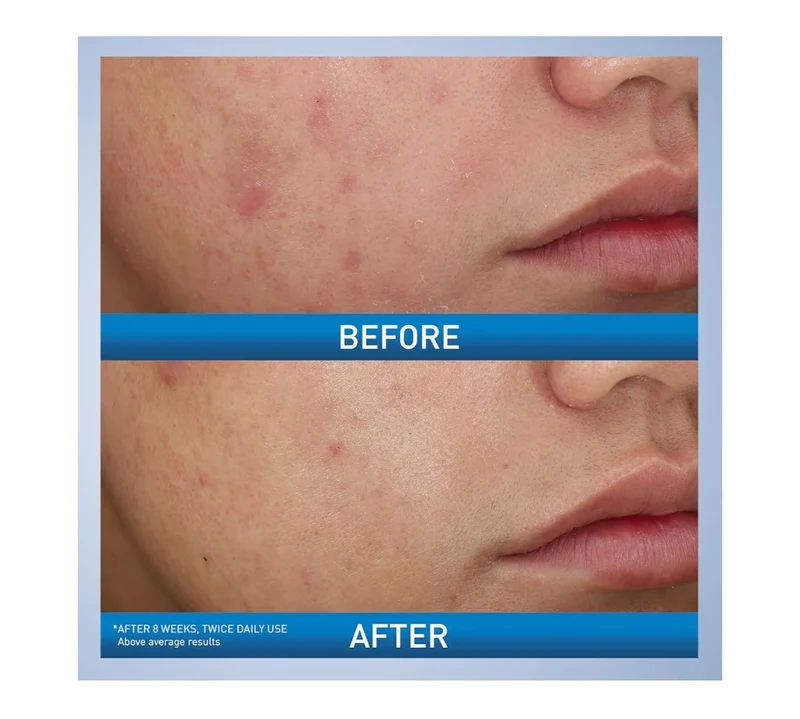 CeraVe Acne Foaming Cream Wash, Gentle Face and Body Cleanser w/ Benzoyl Peroxide 10%, Hyaluronic Acid, and Niacinamide (5 oz)