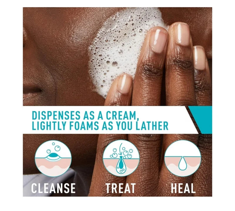CeraVe Acne Foaming Cream Cleanser, 4% Benzoyl Peroxide Face Wash w/ Hyaluronic Acid, Niacinamide & Ceramides