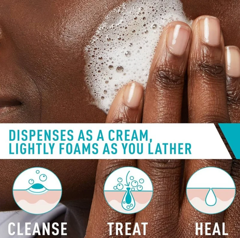 CeraVe Acne Foaming Cream Cleanser, 4% Benzoyl Peroxide w/ Hyaluronic Acid, Niacinamide & Ceramides