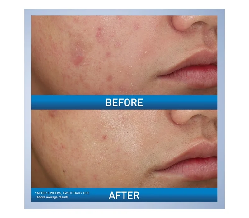 CeraVe Acne Foaming Cream Wash w/ Benzoyl Peroxide 10%, Hyaluronic Acid, and Niacinamide, 10% Benzoyl Peroxide (5 Oz)