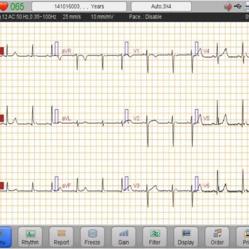 Checkme iE600 6-Channel 12-Lead ECG Machine