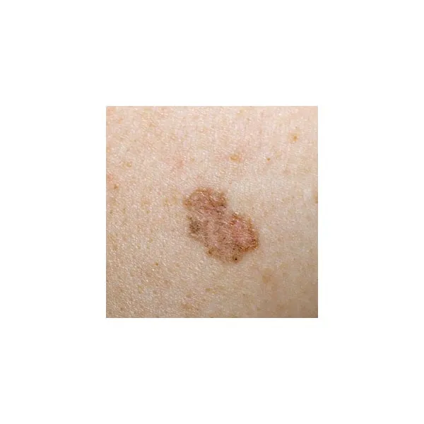 Dermatoscope LuxaScope CCT LED 2.5 V - LUXAMED ®
